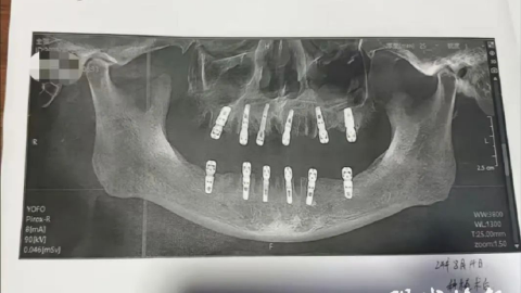 Chinês morre após retirar 23 dentes e implantar outros 12 de uma vez