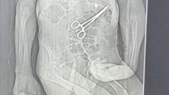 Homem morre na véspera do Natal e família diz que pinça foi deixada em seu corpo após cirurgia