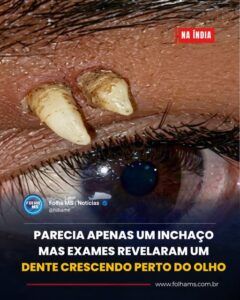 ADOLESCENTE PROCURA HOSPITAL POR INCHAÇO NA SOBRANCELHA E DESCOBRE UM DENTE CRESCENDO PERTO DO OLHO
