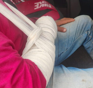 Trabalhador rural sofre suspeita de fratura após ser atingido por portão durante manejo de gado
